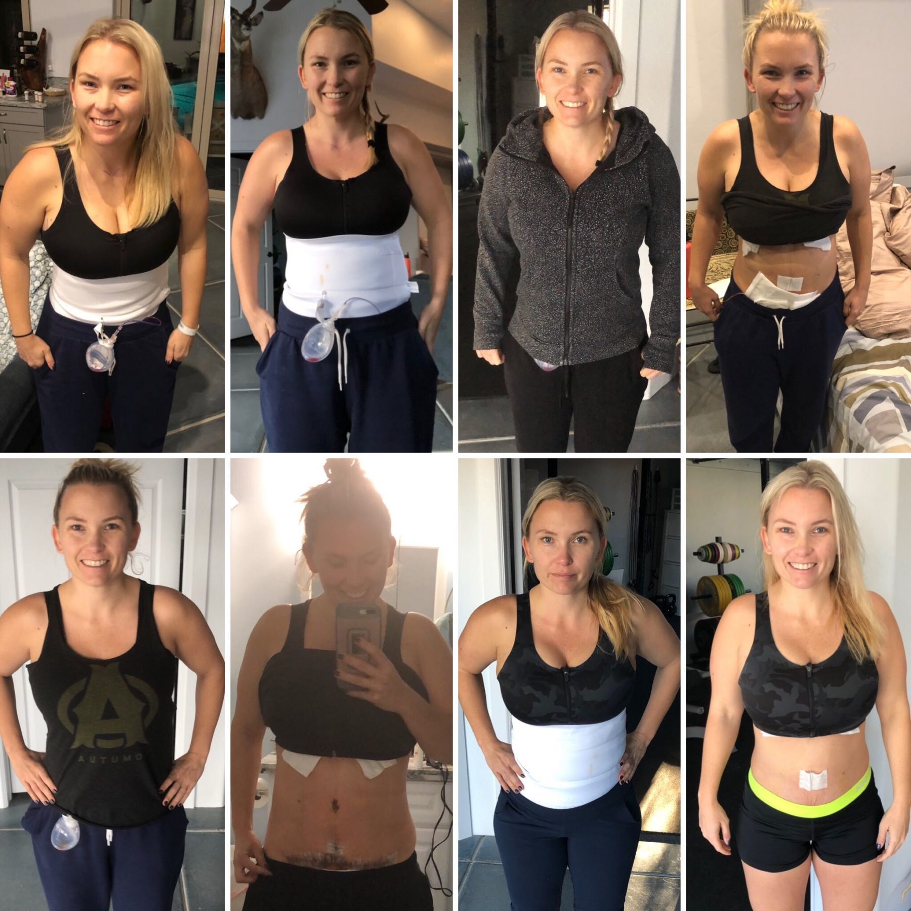 Tummy Tuck Surgery Week-By-Week Recovery Timeline